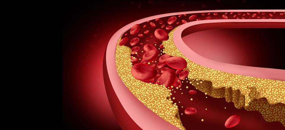 Urolityna A sprzyja stabilności blaszek miażdżycowych poprzez ograniczenie stanu zapalnego i hipercholesterolemii u myszy z niedoborem apolipoproteiny E